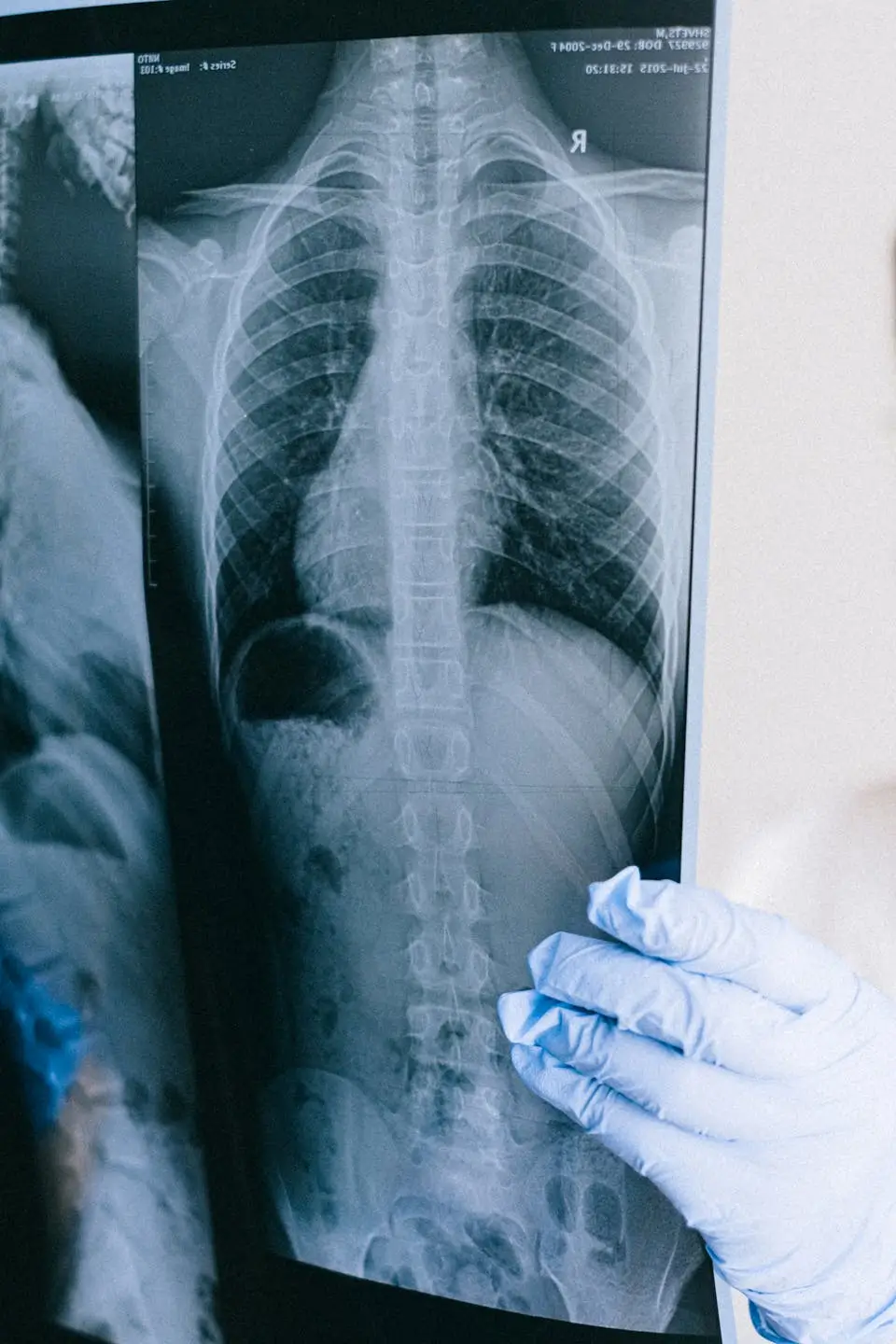 Kanalar Scoliosis